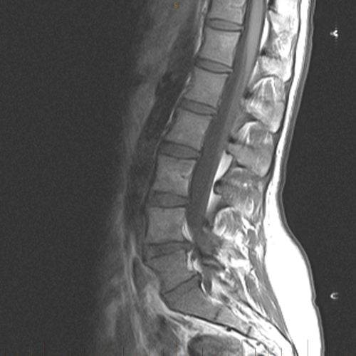 Lumbar Spine showing disc herniation at San Francisco chiropractor's office
